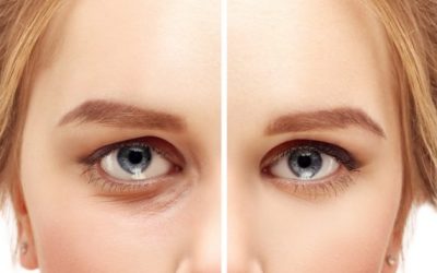 Fractional Plasma Effective for Nonsurgical Blepharoplasty