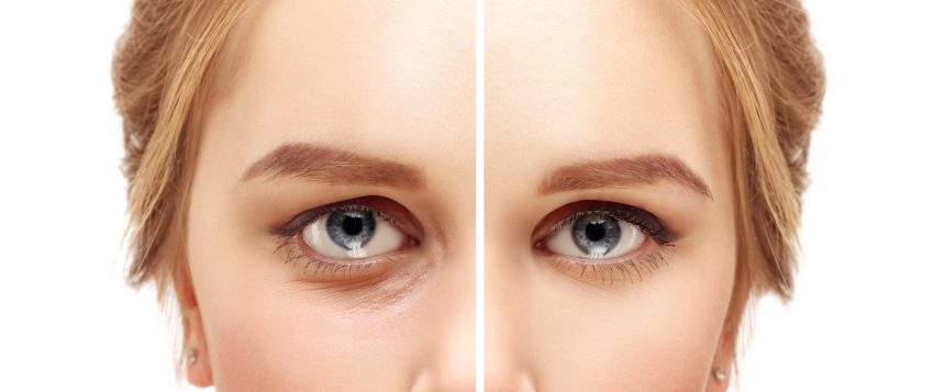 Fractional Plasma Effective for Nonsurgical Blepharoplasty