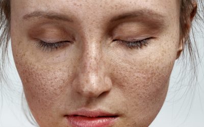 All you need to know about Pigmentation