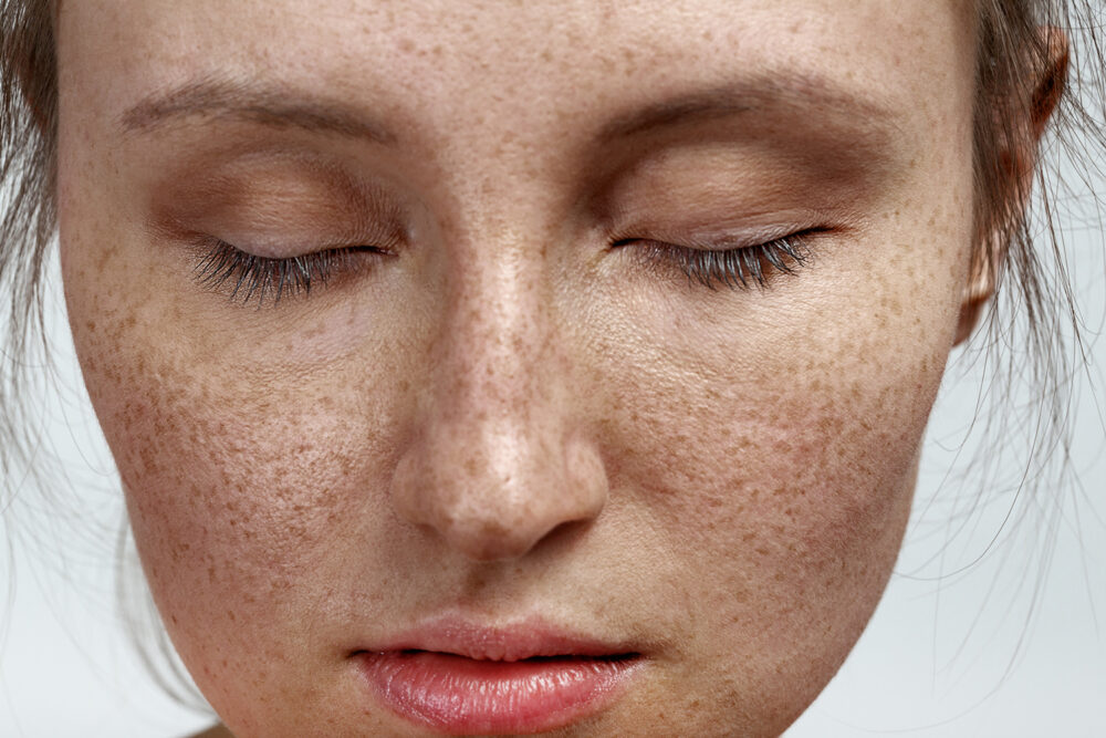 All you need to know about Pigmentation